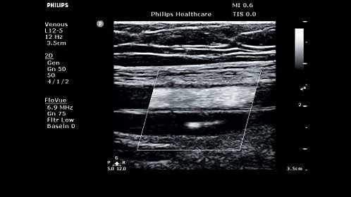 УЗИ аппарат Philips ClearVue 850