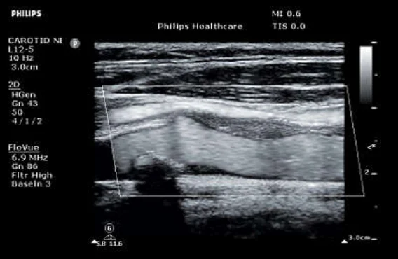 УЗИ аппарат Philips ClearVue 850
