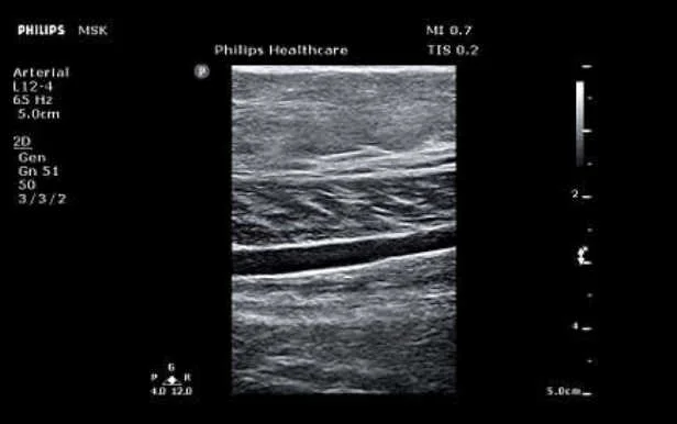 УЗИ аппарат Philips ClearVue 850