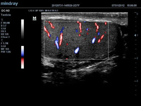 Тестикулярный поток