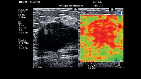 УЗИ аппарат Philips ClearVue 850