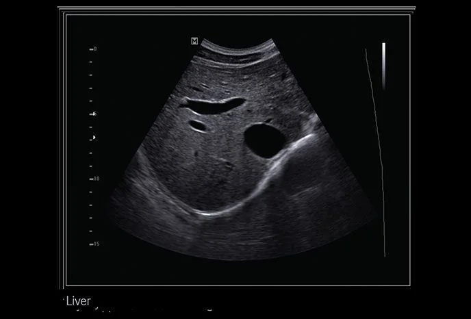 УЗИ аппарат Samsung Medison SonoAce R7