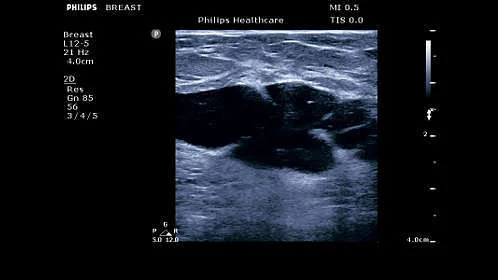УЗИ аппарат Philips ClearVue 850