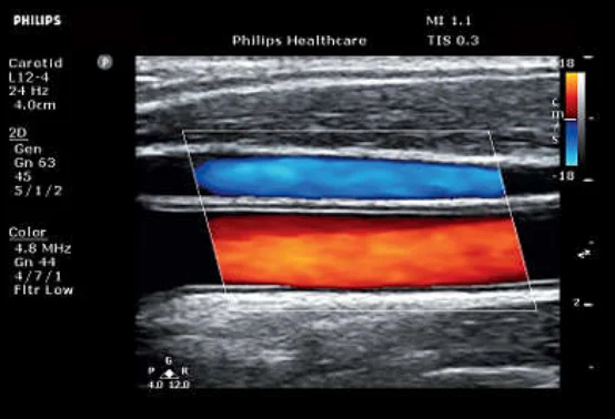 УЗИ аппарат Philips ClearVue 850