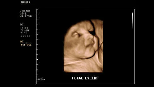 УЗИ аппарат Philips ClearVue 650