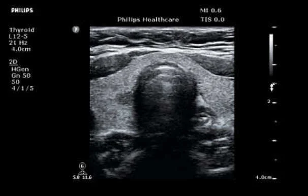 УЗИ аппарат Philips ClearVue 850