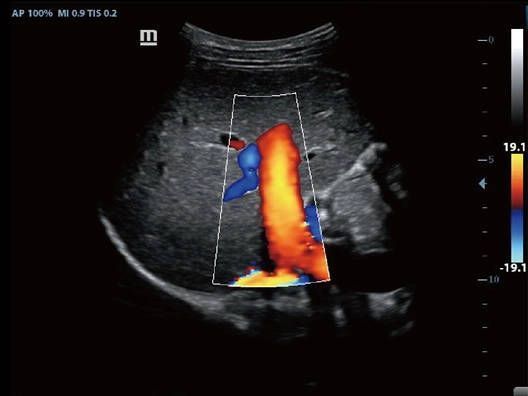 УЗИ Аппарат Mindray Z60