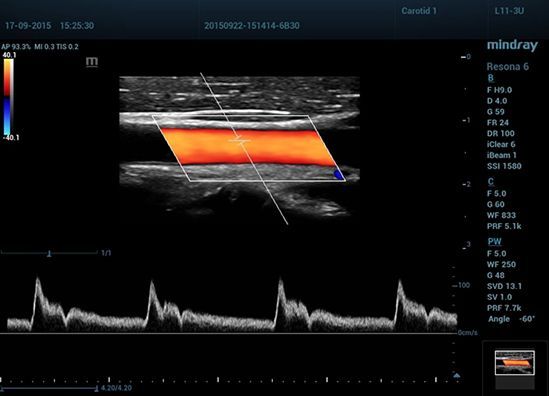 УЗИ аппарат Mindray Resona 6 EXP