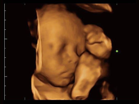 УЗИ Аппарат Mindray Z60