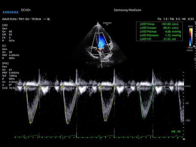 Samsung Medison V6 Samsung Medison V6