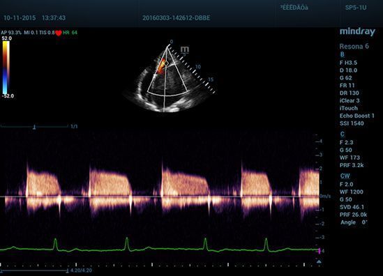 УЗИ аппарат Mindray Resona 6 EXP