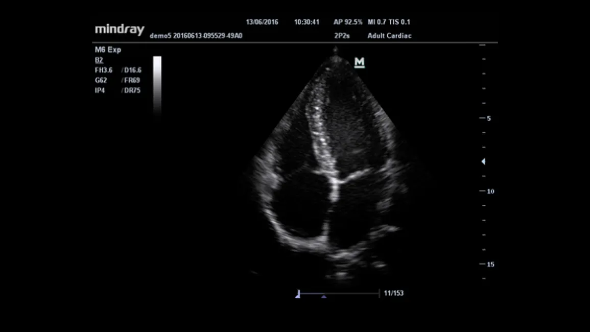 УЗИ аппарат Mindray M6 EXP