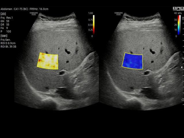 Samsung Medison RS85 Samsung Medison RS85