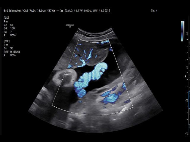 Samsung Medison V6 Samsung Medison V6