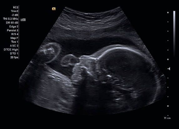 УЗИ аппарат Siemens ACUSON x700