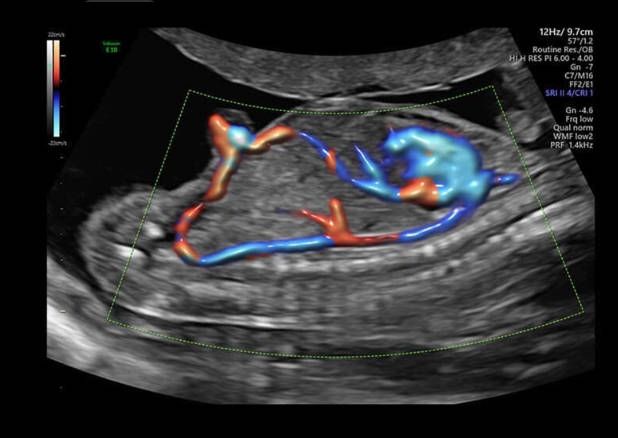 УЗИ аппарат General Electric Voluson E10