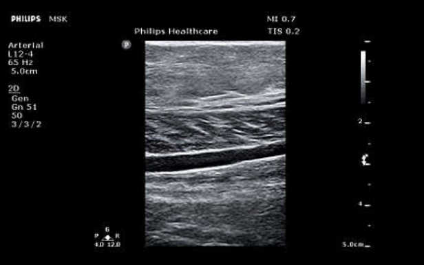 УЗИ аппарат Philips ClearVue 850
