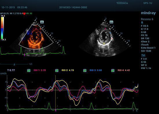 УЗИ аппарат Mindray Resona 6 EXP