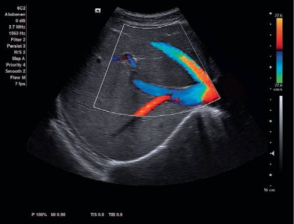 УЗИ аппарат Siemens ACUSON x700