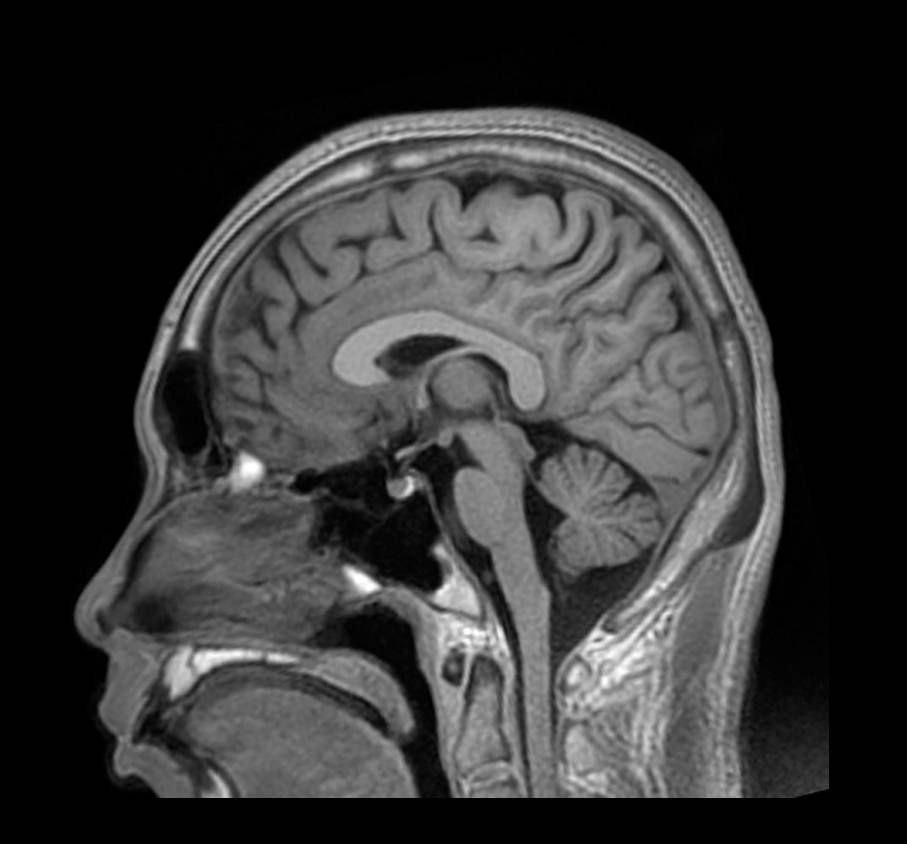 Аппарат МРТ General Electric SIGNA Explorer 1.5Т 60 см