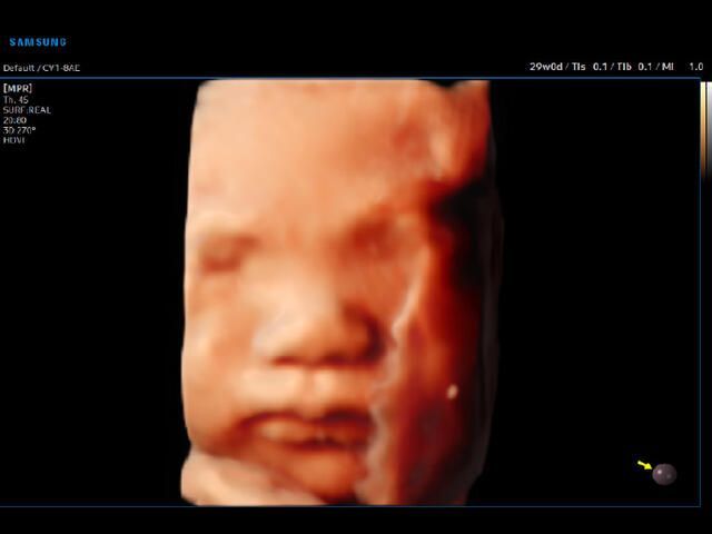 Samsung Medison V6 Samsung Medison V6