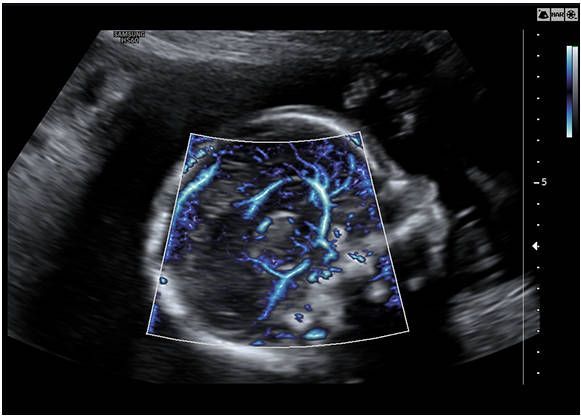 Samsung Medison HS60