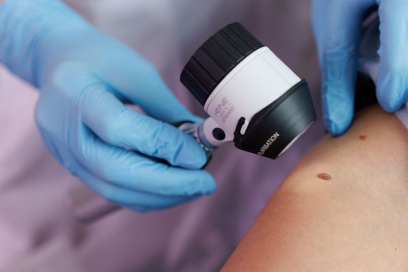 Российская система сможет диагностировать меланому за 30 минут Российская система сможет диагностировать меланому за 30 минут