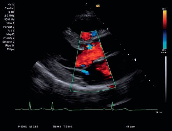 УЗИ аппарат Siemens ACUSON x700