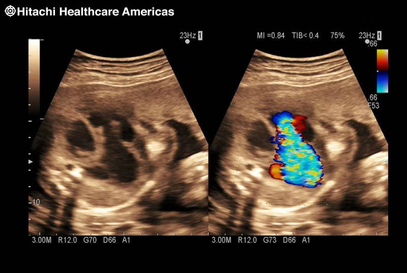 УЗИ аппарат Hitachi Aloka ProSound F37