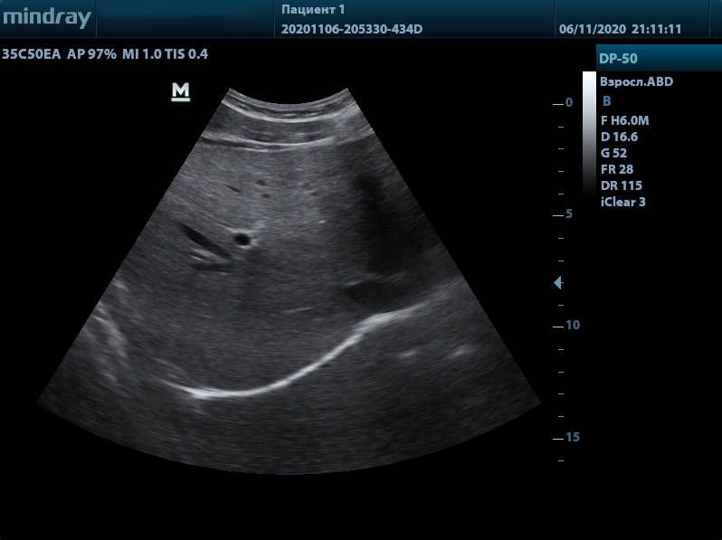 УЗИ аппарат Mindray DP-50 Color
