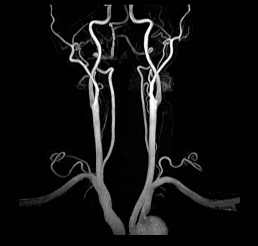 Аппарат МРТ General Electric SIGNA Explorer 1.5Т 60 см