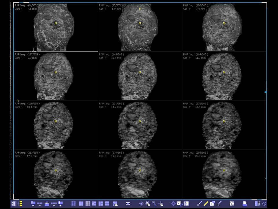 УЗИ аппарат Siemens ACUSON S2000