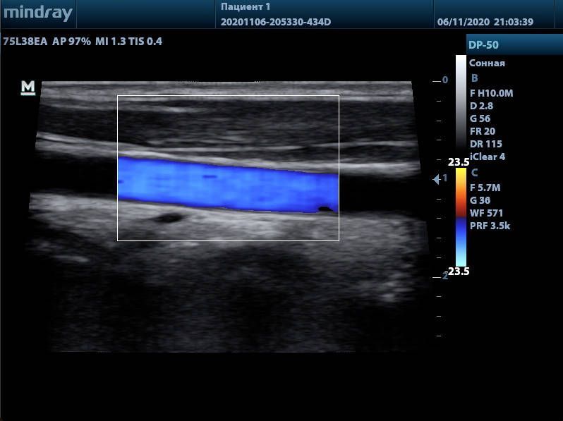 УЗИ аппарат Mindray DP-50 Color