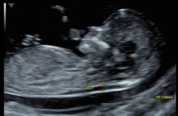 УЗИ аппарат General Electric Voluson E8