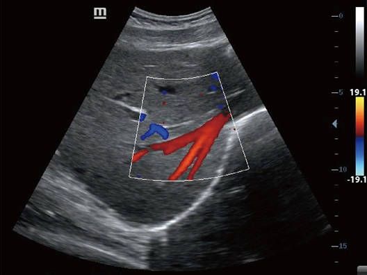 УЗИ Аппарат Mindray Z60