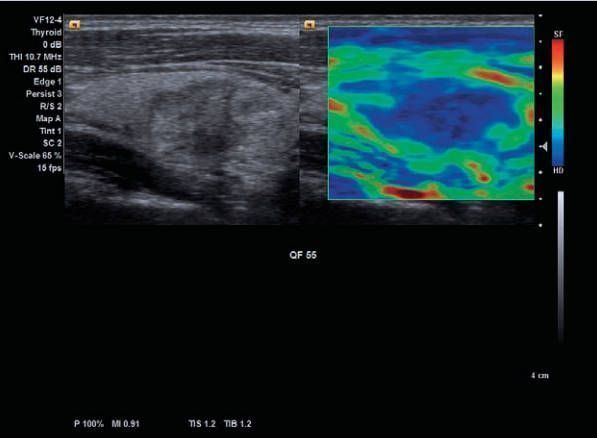 УЗИ аппарат Siemens ACUSON x700