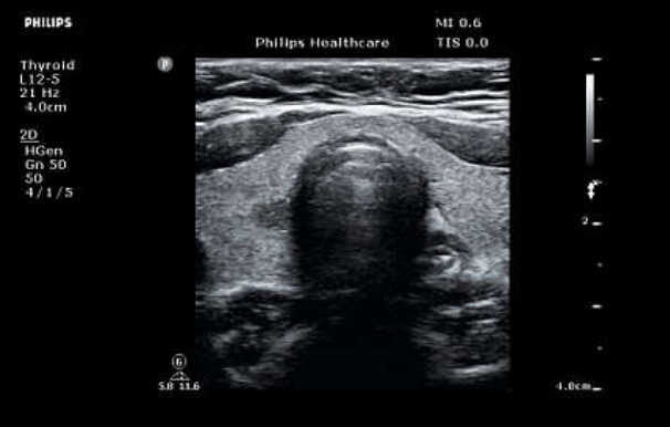 УЗИ аппарат Philips ClearVue 850