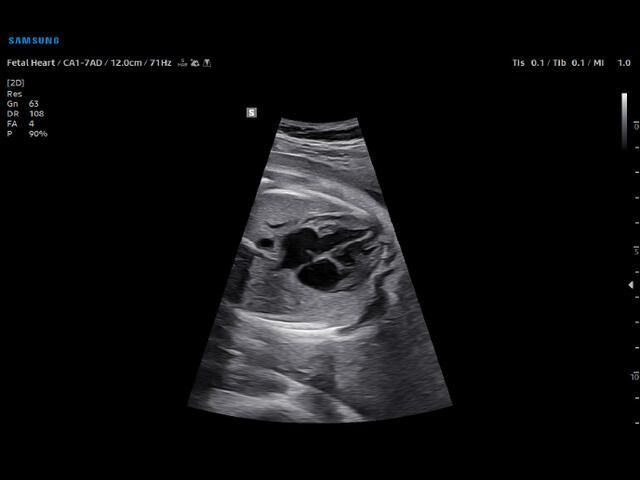 Samsung Medison V6 Samsung Medison V6