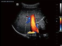 УЗИ Аппарат Mindray Z60