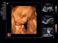 УЗИ аппарат Siemens ACUSON x700