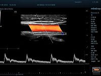 УЗИ аппарат Mindray Resona 6 EXP