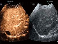 УЗИ аппарат Toshiba Aplio 300