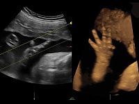 УЗИ аппарат General Electric Voluson E8