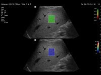 Samsung Medison V8 Samsung Medison V8