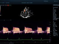 УЗИ аппарат Mindray Resona 6 EXP