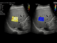 Samsung Medison RS85 Samsung Medison RS85