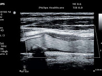 УЗИ аппарат Philips ClearVue 850