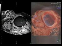 УЗИ аппарат General Electric Voluson E10