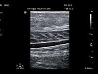 УЗИ аппарат Philips ClearVue 850