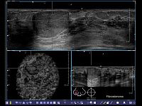 УЗИ аппарат Siemens ACUSON S2000